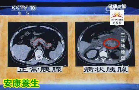 健康之路20150416视频和笔记:急性胰腺炎的表现 诱发急性胰腺炎的行为 胰腺炎的手术治疗