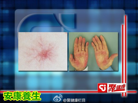 聚健康20150708:闫杰讲《伤肝那些事儿》