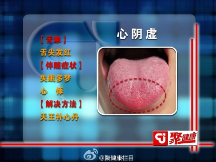 心阴虚