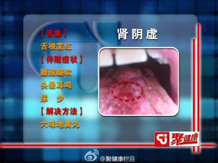 肾阴虚