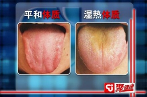 北京卫视20151202聚健康:于振宣讲《望舌辨体质-4》湿热体质的表现及调理 三仁汤