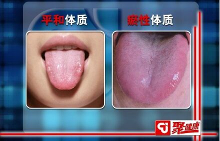 瘀体质的舌象