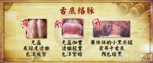 北京卫视20160113养生堂:《古方新用巧降糖—补虚》糖尿病并发症