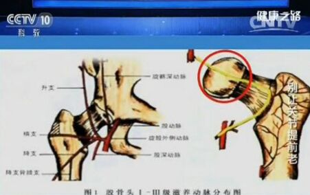 股骨头滋养动脉图