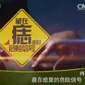 健康之路20160128视频笔记:曹梅讲藏在痣里的危险信号（上）
