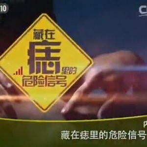 健康之路20160129笔记:曹梅讲藏在痣里的危险信号（下）蜘蛛痣、黑色素瘤