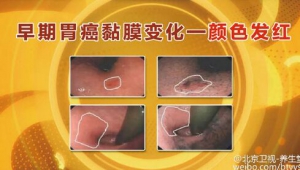 北京卫视20160316养生堂:《抗癌也有“组合拳”——胃癌》胃癌的四大症状及筛查