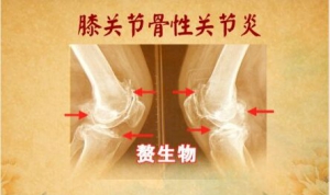 养生堂20160327视频和笔记:《膝活筋柔人不老》膝关节骨性关节炎、骨刺