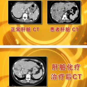养生堂20160402视频笔记:《抗癌也有组合拳—3》防癌抗癌、癌症的综合治疗