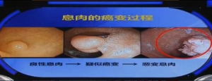 健康之路20160415视频和笔记:刘骞《能治好的癌症（一）》肠镜筛查的意义
