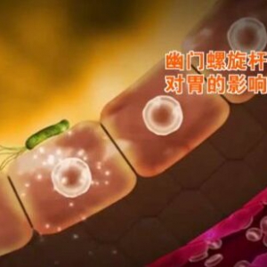 北京卫视20160418养生堂:幽门螺杆菌的危害、胃癌与幽门螺杆菌的关系