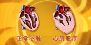 北京卫视20160513养生堂视频笔记:心脏“减肥”、心肌肥大、心悸、气喘、咳嗽