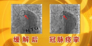 北京卫视20160524养生堂:甄文俊、刘兵、冠心病的诱发因素和预防、心脏搭桥手术
