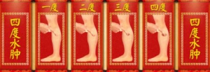 北京卫视20160526养生堂:王肃季、肾病综合征的早期表现及预防调理