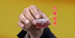 北京卫视20160531养生堂:张耀光、泌尿感染、膀胱结石、肉眼血尿 、膀胱癌