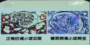 健康之路20160704视频笔记: 周福德、别让慢病伤了肾（上）