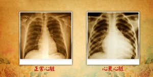 北京卫视20160717养生堂视频和笔记：《揭开迷雾保心脏》