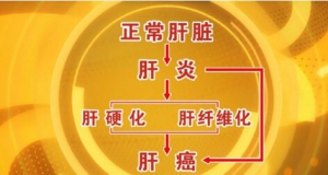 北京卫视20160818养生堂视频笔记：《警惕“致命”的肝炎》