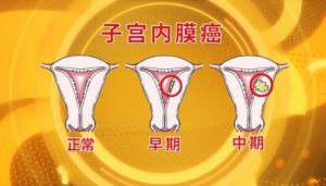 北京卫视20160826养生堂：雌激素、子宫内膜癌的症状辨别和预防