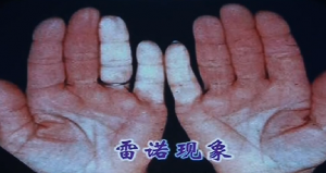 健康之路20160921视频笔记: 风湿病的非常信号（下）干燥综合征、口腔溃疡
