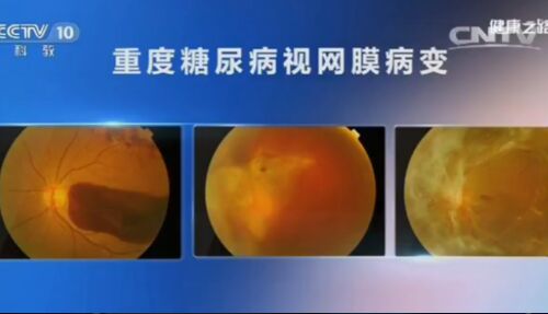 健康之路20161016:魏文斌《透过眼睛看健康》糖尿病、高血压、视网膜病变