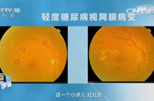 健康之路20161016:魏文斌《透过眼睛看健康》糖尿病、高血压、视网膜病变