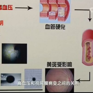 健康之路20161016:魏文斌《透过眼睛看健康》糖尿病、高血压、视网膜病变