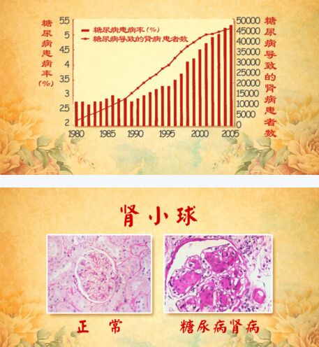 北京卫视20161112养生堂:刘玉宁、刘伟敬《关上肾脏损伤的大门》糖尿病肾病
