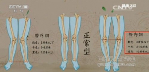 健康之路20161215曹永平《腿部变形记》腿部变形的自测