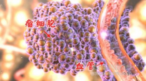 北京卫视20161225养生堂、李辉《防癌秘诀家中寻-3》肺癌