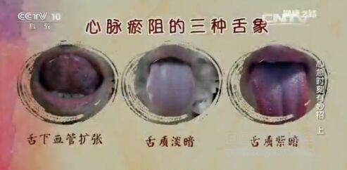 健康之路20170104贾海忠《心急时刻有妙招(上)》心脉瘀阻的三种舌象