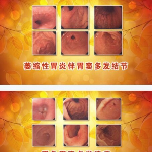 北京卫视20170105养生堂《消化重症的“逆转术”》