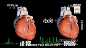 健康之路20170112华伟《心跳会说话》室颤、房颤
