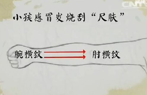 健康之路20170210王莹莹《手到病除(上)》刮痧