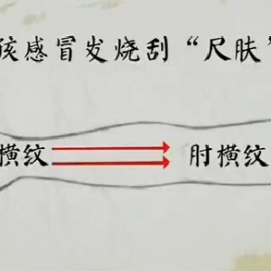 健康之路20170210王莹莹《手到病除（上）》刮痧