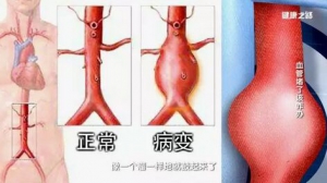 健康之路20170526刘鹏《血管堵了该咋办》腹主动脉瘤