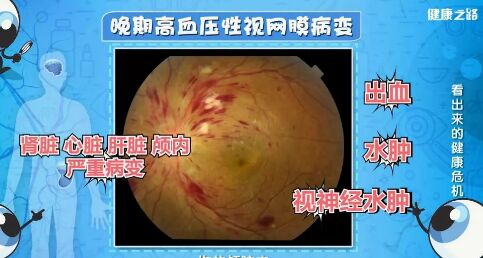 20190227健康之路视频笔记《看出来的健康危机》