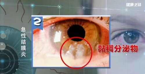 20190228健康之路视频笔记《眼睛红 不简单》