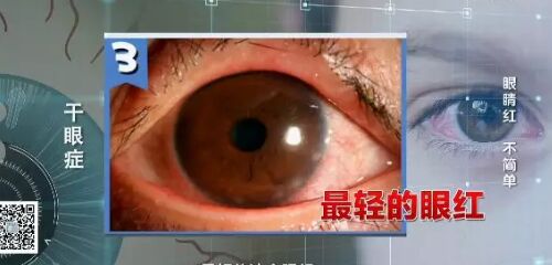20190228健康之路视频笔记《眼睛红 不简单》