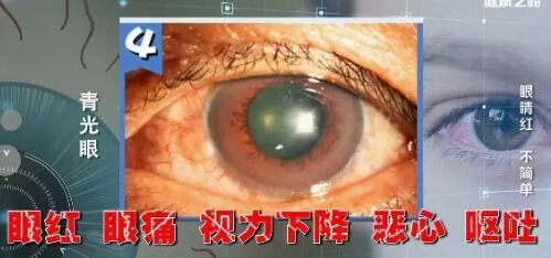 20190228健康之路视频笔记《眼睛红 不简单》