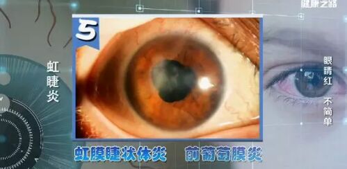 20190228健康之路视频笔记《眼睛红 不简单》