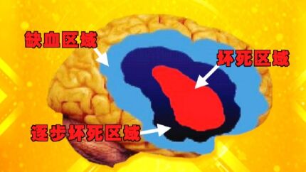 20190403养生堂视频和笔记:徐玢,杜万良《识别中风的“加速度”》