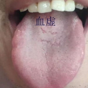 认识四种裂纹舌，十种舌象